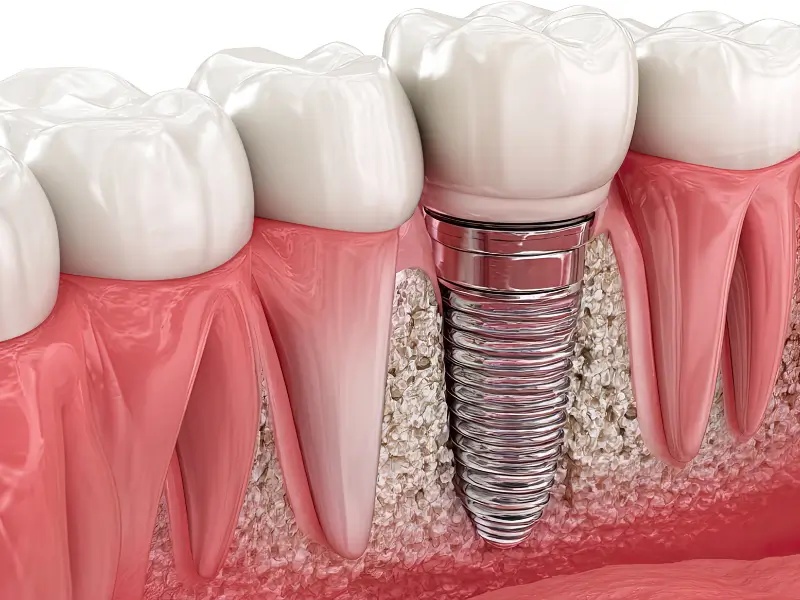 Dental implant illustration