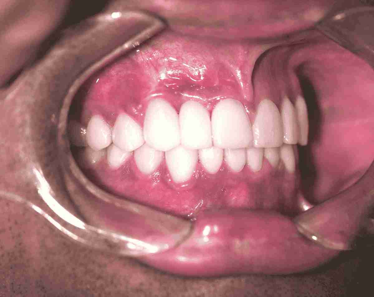 images/uploaded/images/after-dental-implants-1-1.png