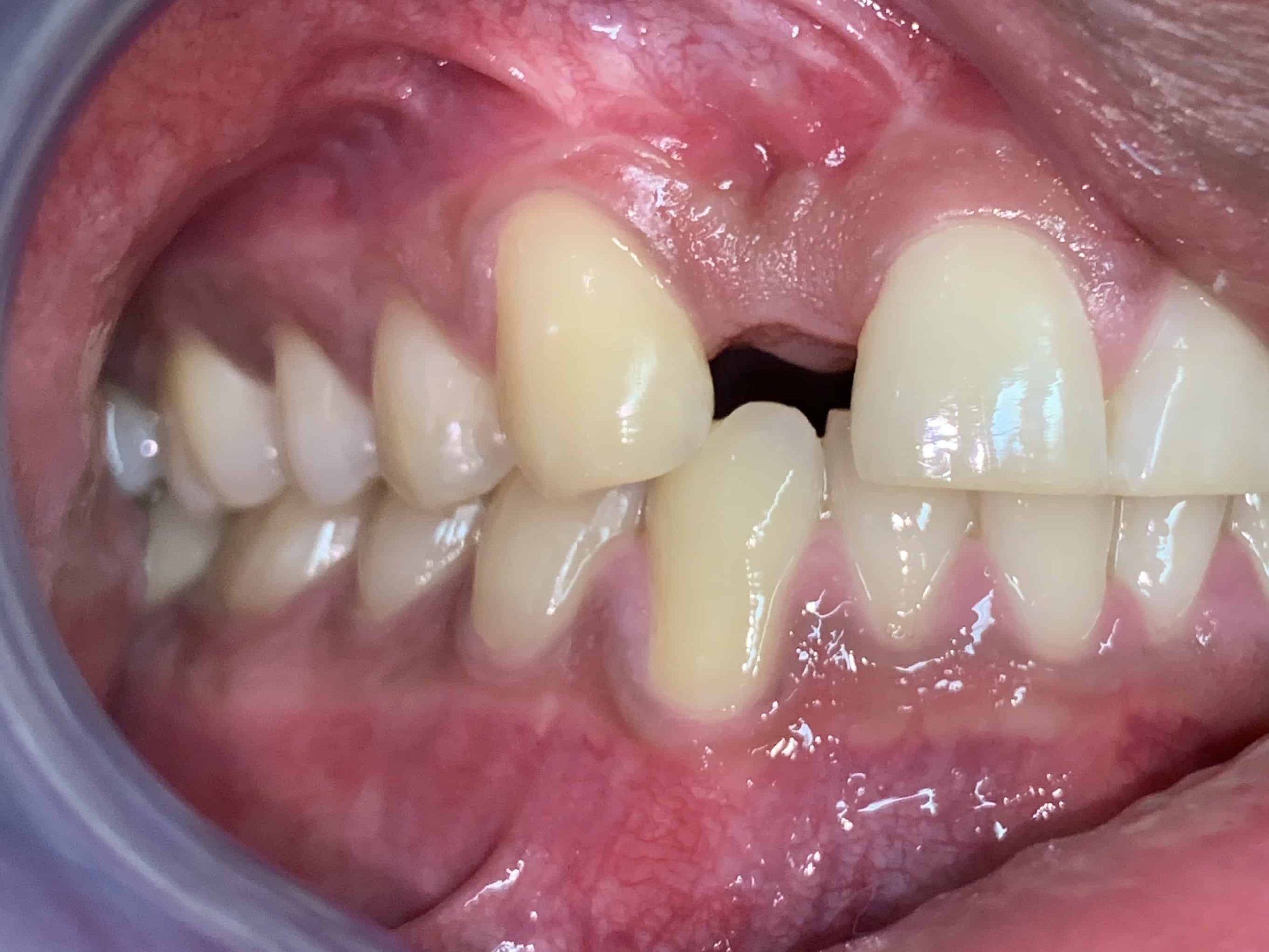 before-dental-implants-1-2048x1536.jpg