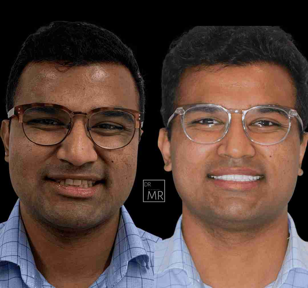 teeth-whitening