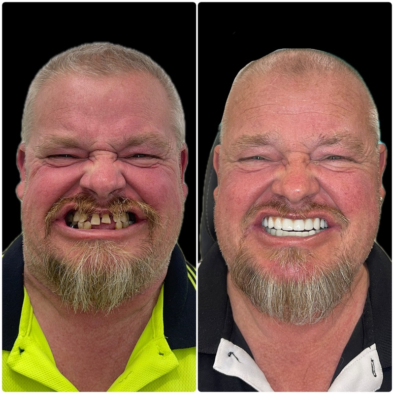 teeth-whitening