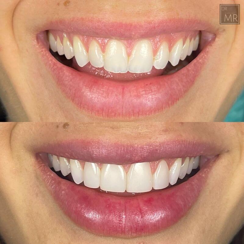 veneers.jpeg