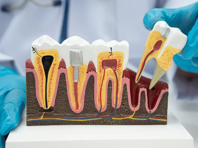 Root Canal Procedure