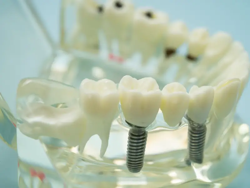 Root Canal Procedure