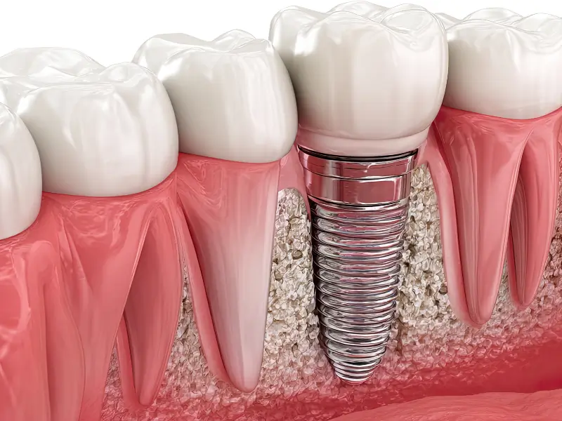 Dental Implants