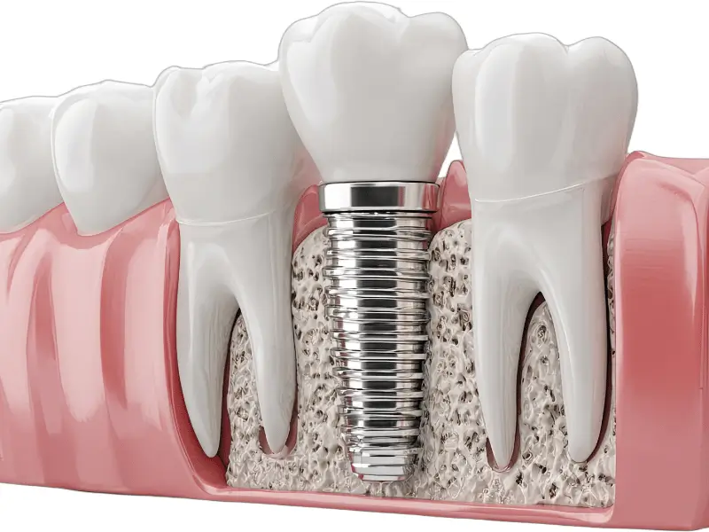 Root Canal Treatment
