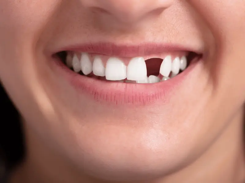 Bone Loss and Missing Teeth