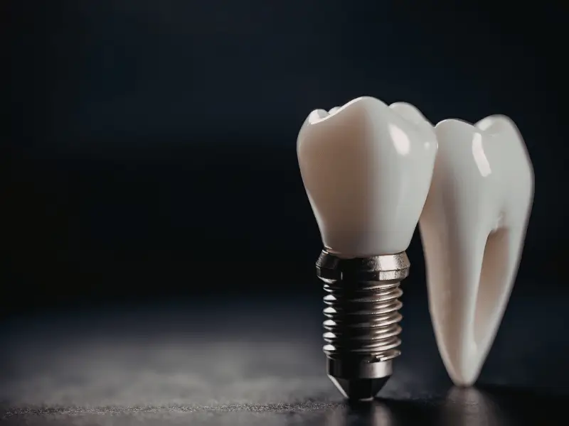 Dental Implants