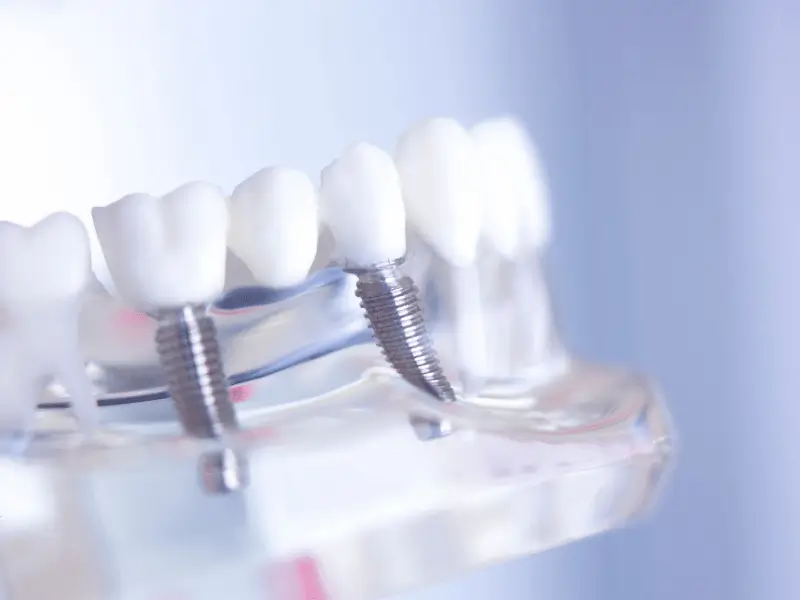 Dental Implants